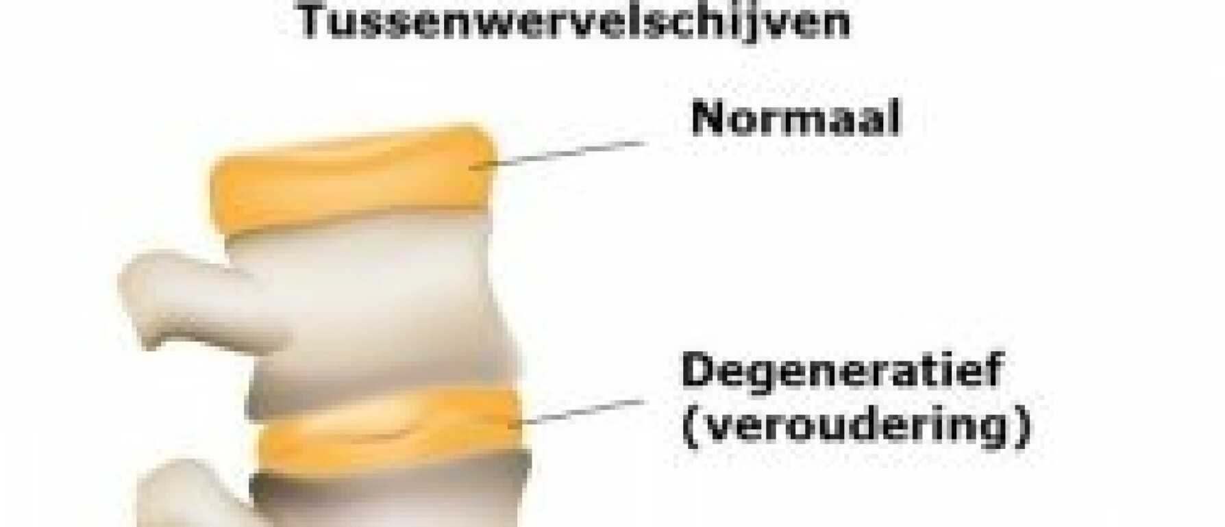 Alles Over Stenose In De Nek Symptomen En Behandeling