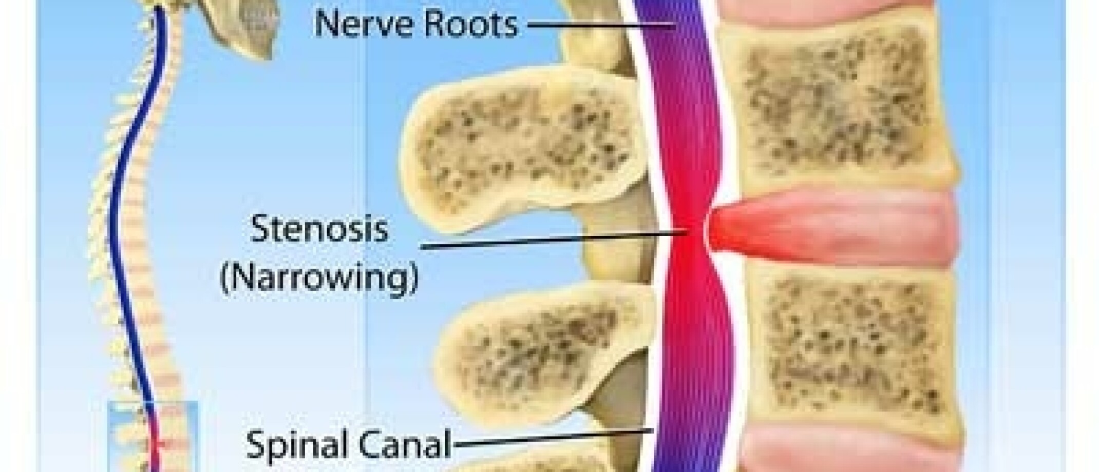 Alles over Stenose in de nek symptomen en behandeling