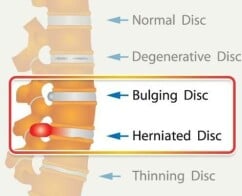 Acute hernia - oorzaak, symptomen en behandeling