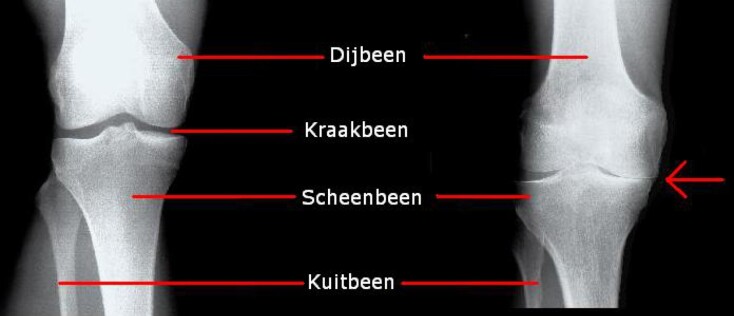 Is artrose reversibel? Steeds meer onderzoek laat verrassende resultaten zien