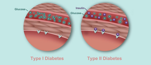 Diabetes type 1