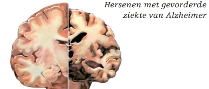 De rol van vasten bij de ziekte van Alzheimer