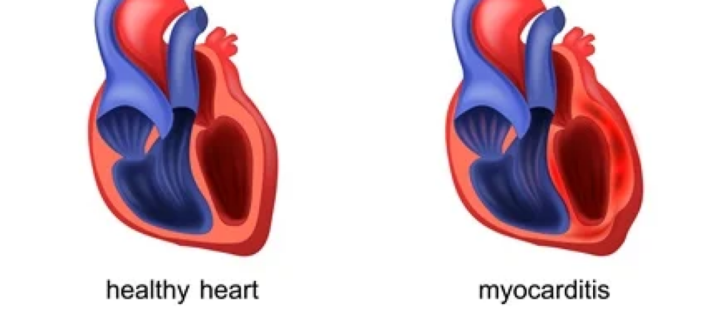 Is myocarditis ernstig