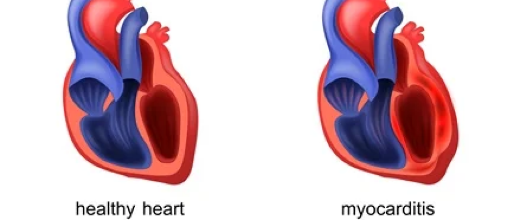 Hoelang duurt myocarditis