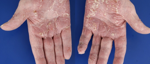 Psoriasis handen