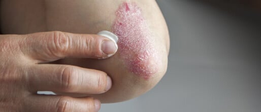 Psoriasis huidziekte