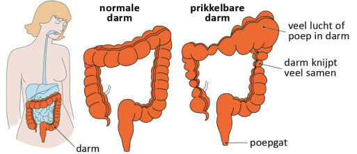 Prikkelbare Darm Syndroom