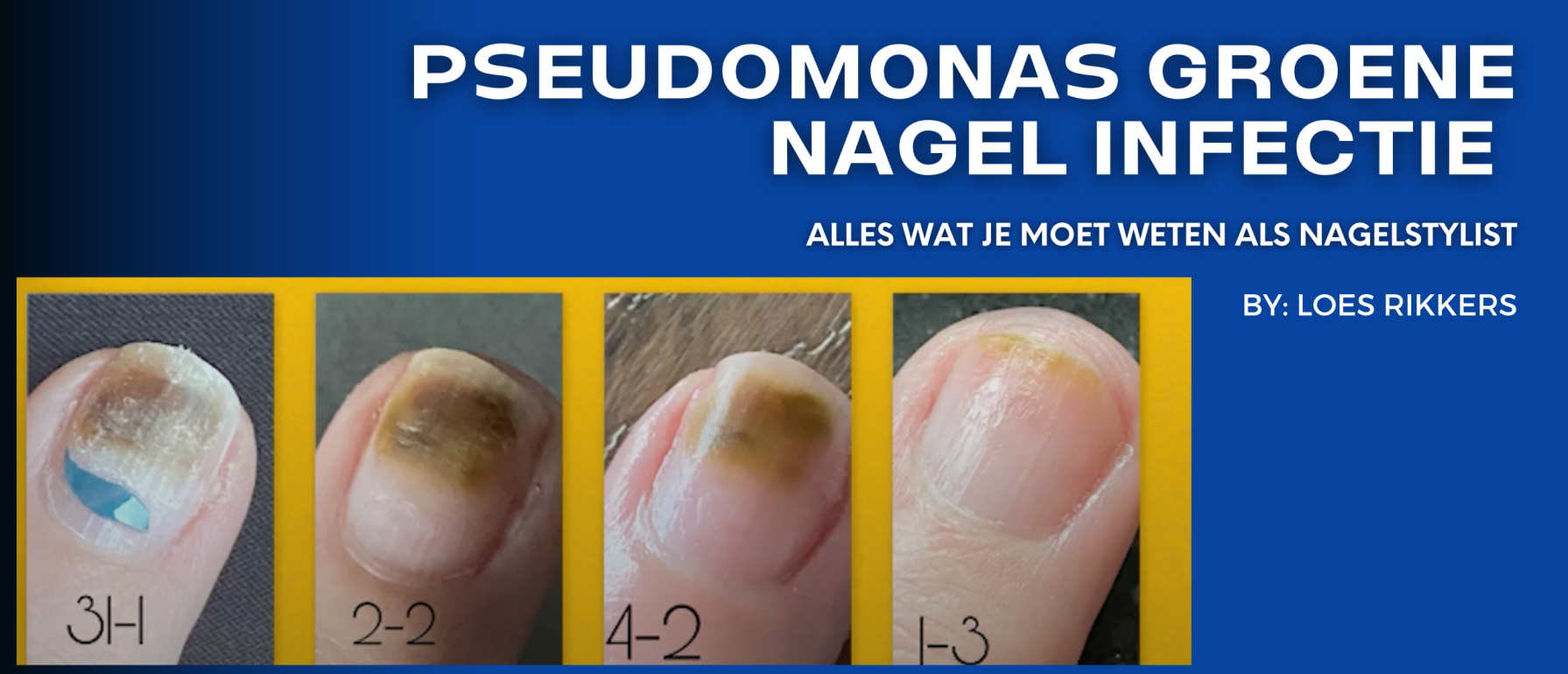 Pseudomonas Groene Nagel Infectie