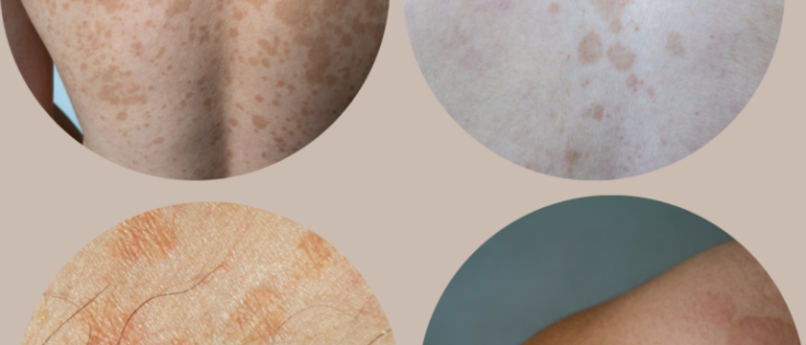 Pityriasis Versicolor: oorzaak en behandeling van zomergist