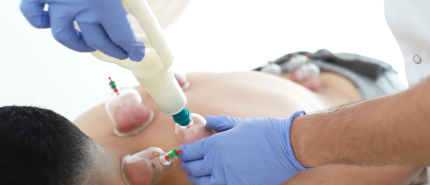 Cupping bij spierpijn en sportblessures: wat werkt en wanneer?