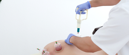 Dry cupping vs hijama: wat is het verschil?