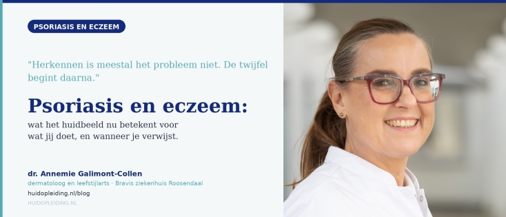 Psoriasis en eczeem: de twijfel begint na het herkennen