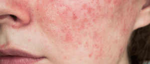 Voeding en rosacea: Wat kun je beter wel en niet eten?