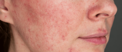 Bindweefsel en (acne)littekens: hoe massage en voeding je huid écht kunnen verbeteren!