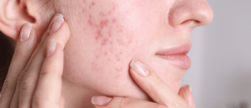 Bindweefselmassage bij Rosacea