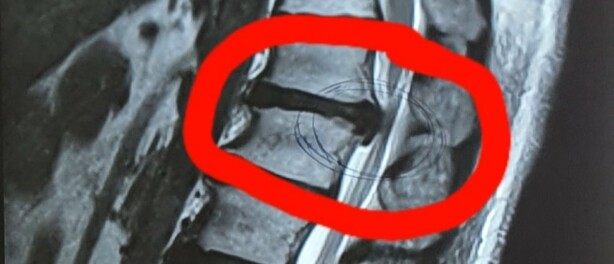Rugpijn?  De oorzaak is toch op een scan te zien?