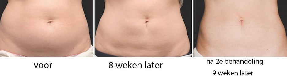 buikvet kwijtraken door bevriezing