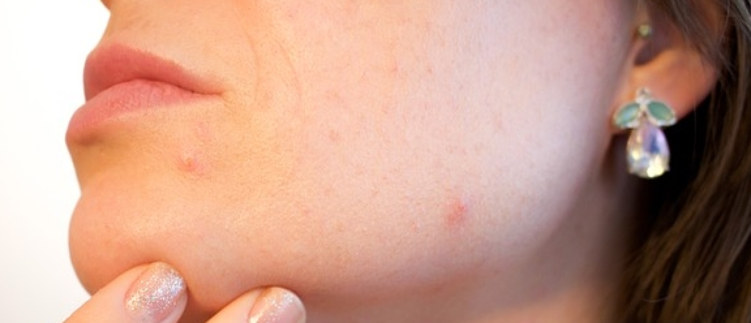 Collageen en acne: Helpt collageen tegen acne?