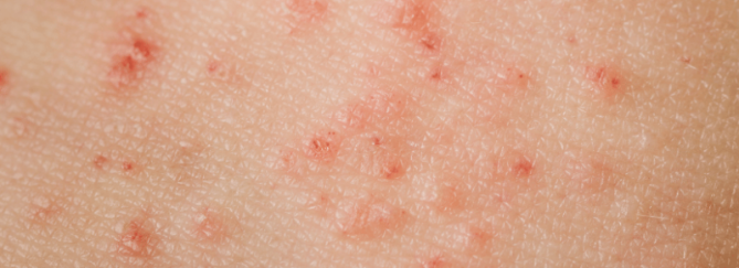 Kleine rode jeukende bultjes | Waar heb ik last van? En wat kan ik er