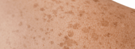 Bruine Vlekken Op De Huid Welke Vormen Zijn Er En Hoe Kom Je Er Vanaf bruine-vlekken-op-de-huid-welke-vormen-zijn-er-en-hoe-kom-je-er-vanaf
