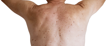 Bruine vlekken op huid: donkere vlekken op huid door pigment