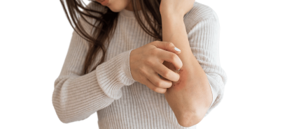 Winter eczeem gezicht en lichaam