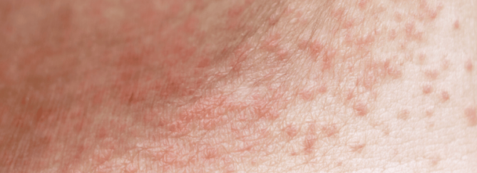 Warmtebultjes | Oorzaak en Tips | Sproet