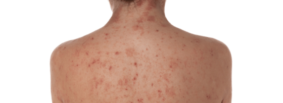 Rode vlekken op de huid | Oorzaak en mijn tips als huidtherapeut