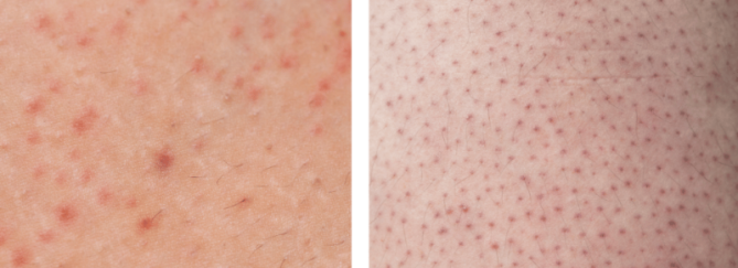 Keratosis Pilaris | Rode puntjes huid | In 3 stappen er vanaf!