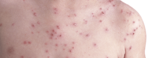 Waterpokken kind | Snel van de jeuk af!