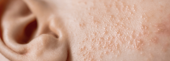 Warmtebultjes | Oorzaak en Tips | Sproet