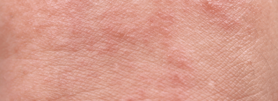 Voet eczeem | Oorzaak en tips | Sproet