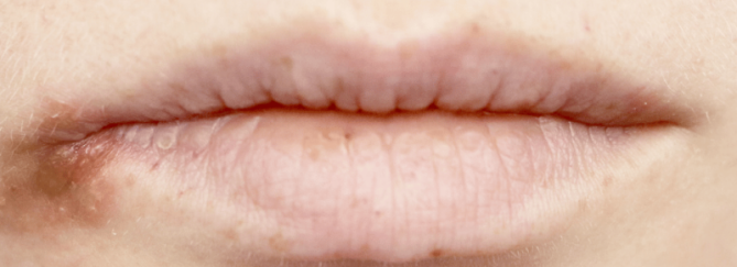 Gescheurde mondhoeken | Zo kom je er snel vanaf! | Advies huidtherapeut