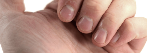 Kapotte nagelriemen | Mijn tips! | Sproet