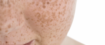 Sproeten: kleine bruine vlekjes