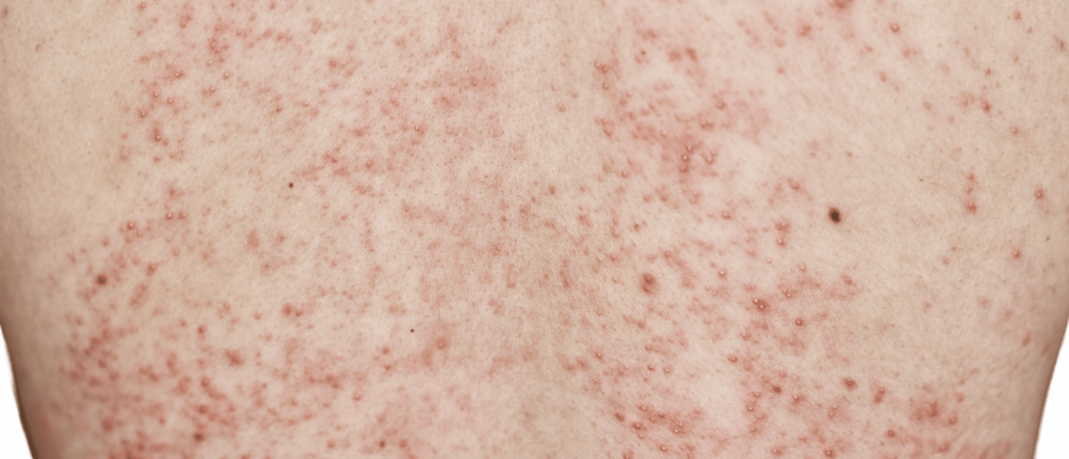 Ziekte van Grover | Jeukende bultjes | Mijn tips als huidtherapeut