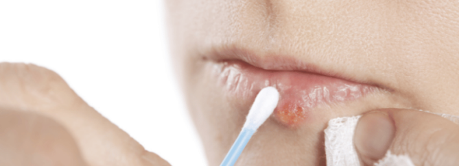 Herpes labialis: koortslip | Mijn tips als huidtherapeut