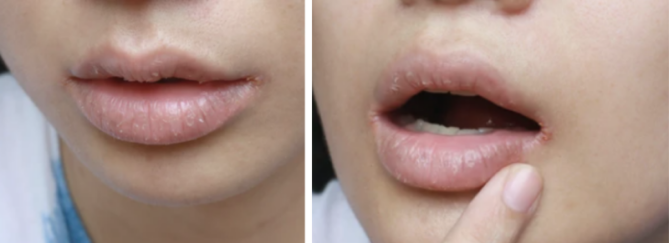Gescheurde mondhoeken | Zo kom je er snel vanaf! | Advies huidtherapeut