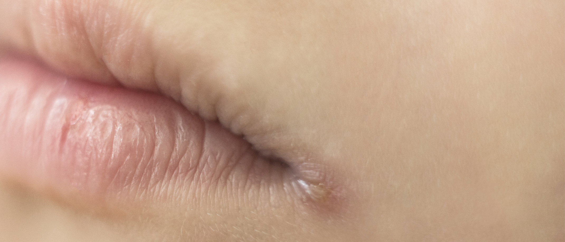 Gescheurde mondhoeken | Zo kom je er snel vanaf! | Advies huidtherapeut