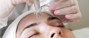 Microneedling