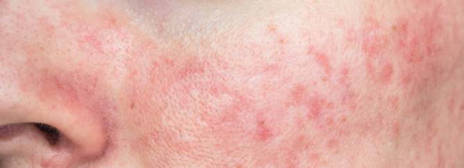 Rode huid gezicht | Oorzaak en tips | Sproet