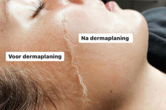 Met Dermaplaning Verminder Je Rimpels En Krijg Je Een Gladde Huid.