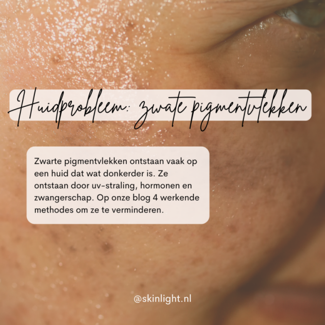 Bruine Vlekken op Wangen en Voorhoofd Zo kom je er vanaf
