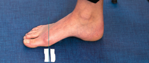 Wat helpt tegen neuropathie bij diabetes?