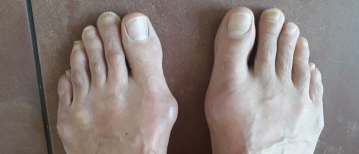 Hallux valgus: krijg een rechtere teen en loop weer lekker met Voetentraining