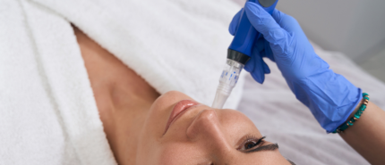 Ontdek Microneedling: Natuurlijke Verjonging bij Suzan Oerlemans HUIDINSTITUUT