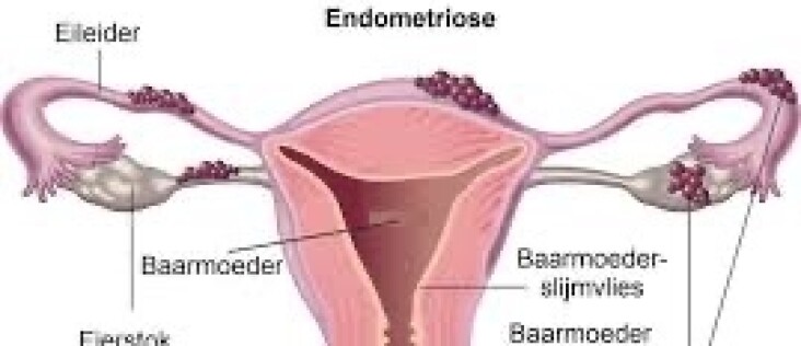 Endometriose: Wanneer je baarmoederslijmvlies besluit om te gaan backpacken door je lichaam