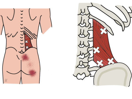 De Oplossing Voor Jouw Bil-, heup-, en Rugklachten