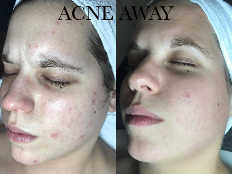 Geweldig resultaat bij acne huid van een acne away klant.