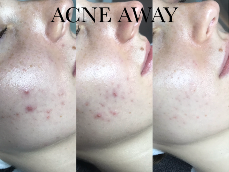 Acne away klant geweldig resultaat bij haar acne huid door acne away concept